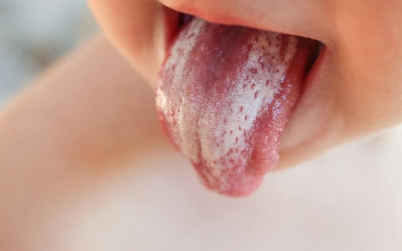 Milk tongue vs Thrush